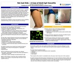 Not Just Kids –A Case of Adult IgA Vasculitis by Heidi Reich and Jeff Youker